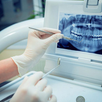 Внутриротовой снимок во время лечения зуба