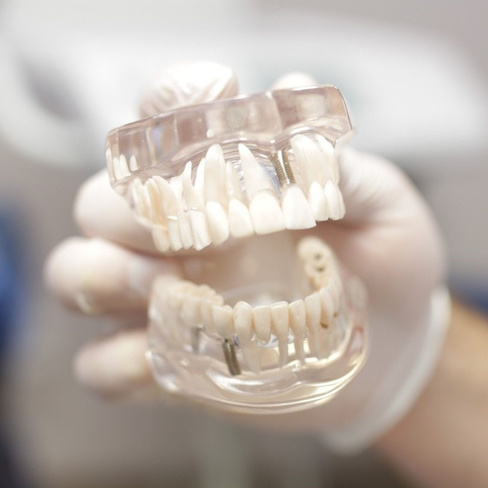 Временная коронка (зуб) из РММА, изготовленная методом CAD/CAM