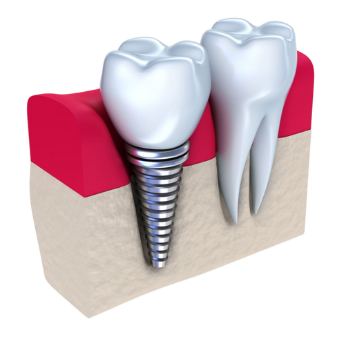 Протезирование зуба с использованием имплантата